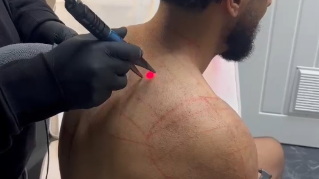 Shoulder Hair Removal for Men: The Complete Laser Guide (Bradford and Oldham)