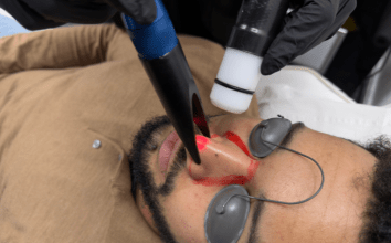 Beyond the Fade How Laser Enhances Men’s Grooming and Confidence