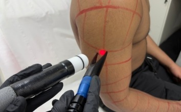 From Irritation to Confidence A Client’s Journey with Alpha Laser Clinic