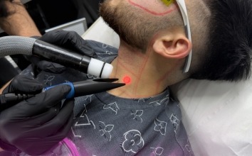 Laser Hair Removal for Different Skin Types and Hair Textures The Alpha Guide to Safe, Effective Results