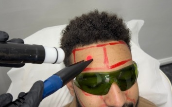Ingrown Hairs After Laser Removal: Prevention and Treatment Guide