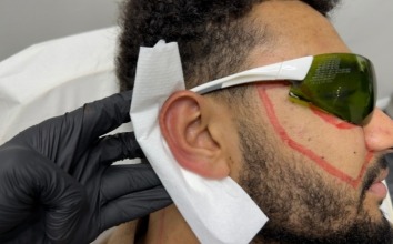 Precision Under Pressure What Alpha Laser Clinic and Premier League Football Have in Common