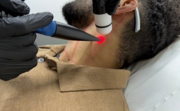 ND:YAG Laser vs IPL: Why Medical-Grade Technology Matters for Men