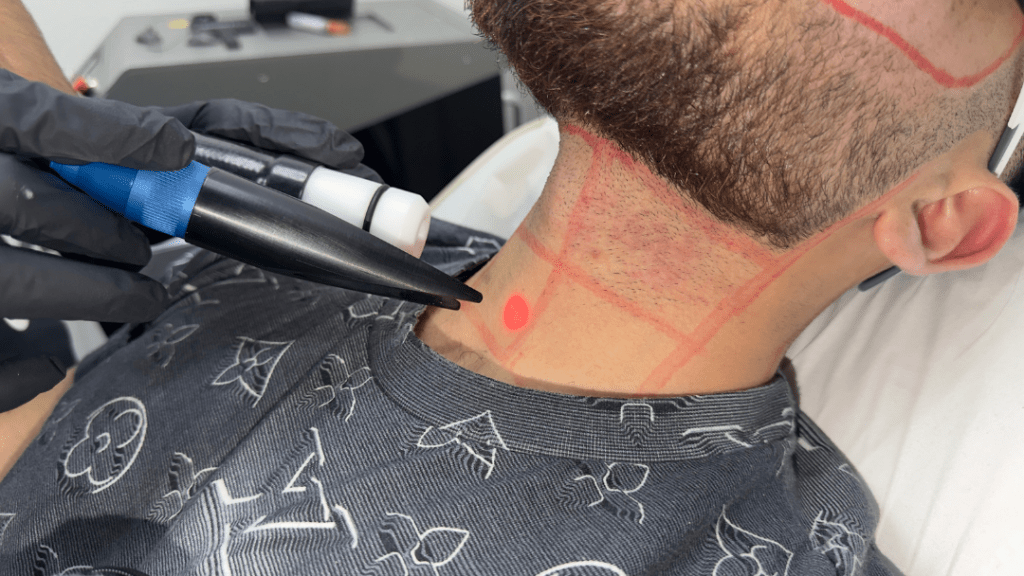 Why Elite Athletes Choose Laser Hair Removal The Performance Advantage