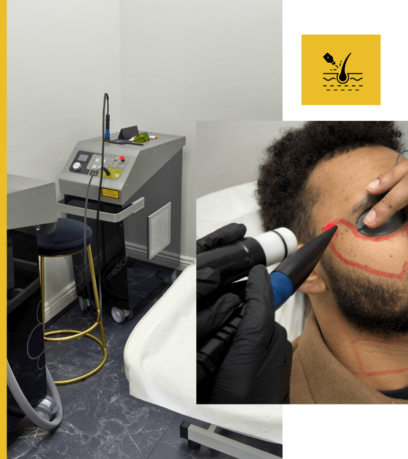 Laser Hair Removal Treatment For Men In Bradford And Oldham