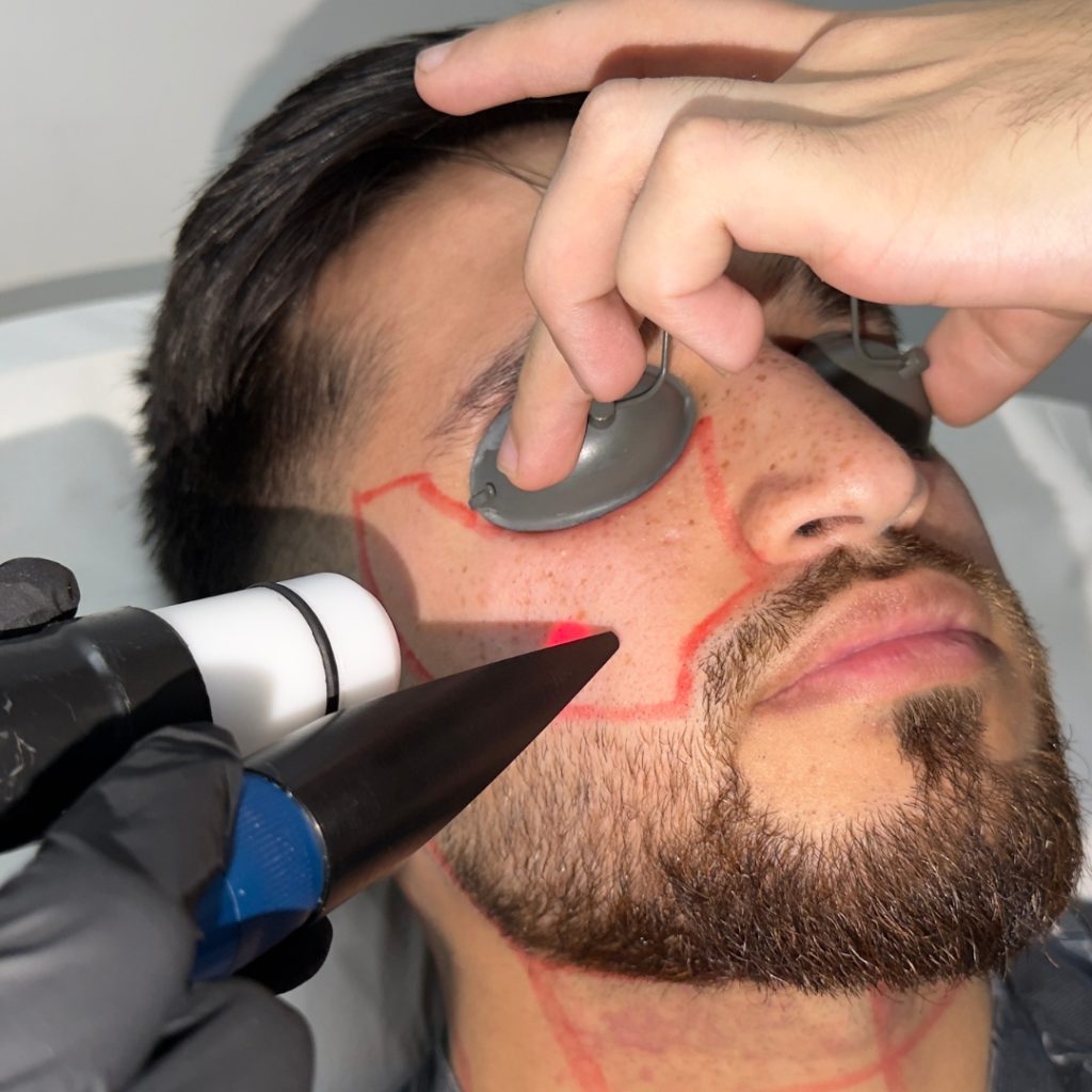 Beard Line Laser Shaping for Men: Get the Design Right First