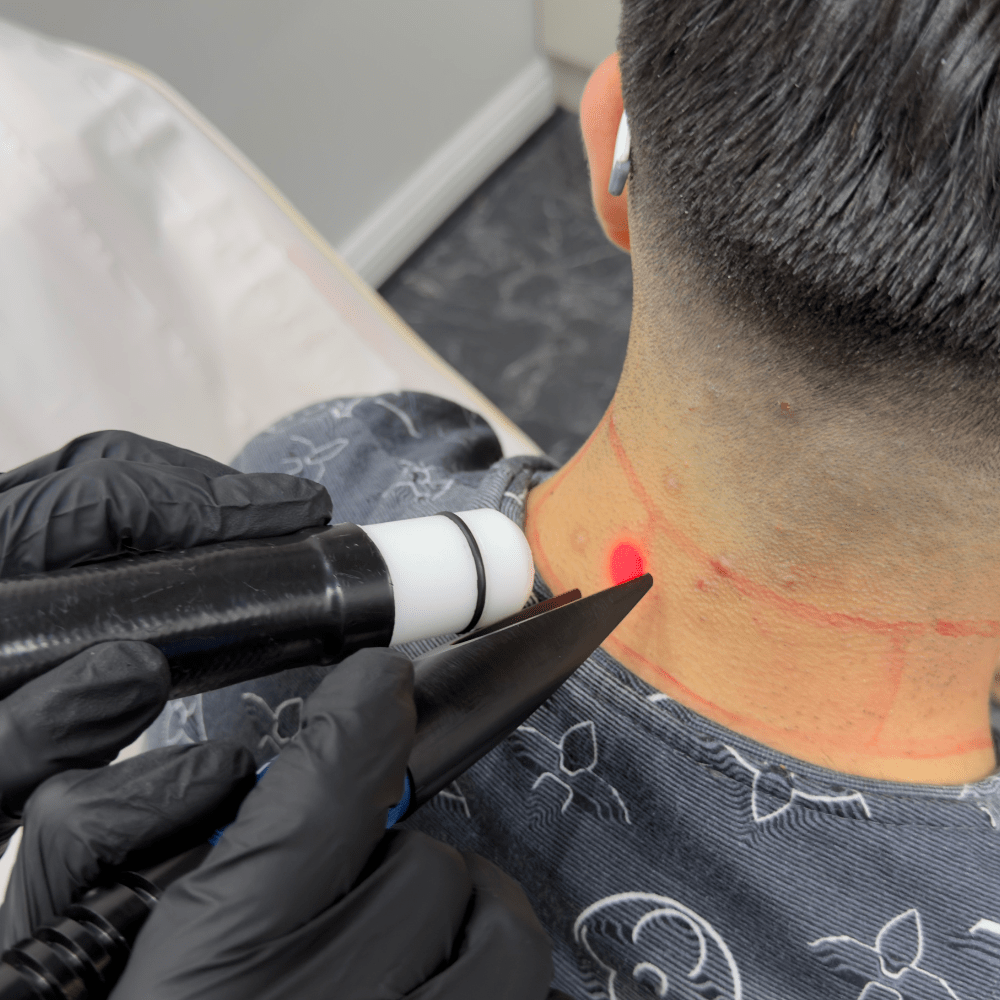 The Complete 6-Month Laser Hair Removal Timeline: Results You Can Expect