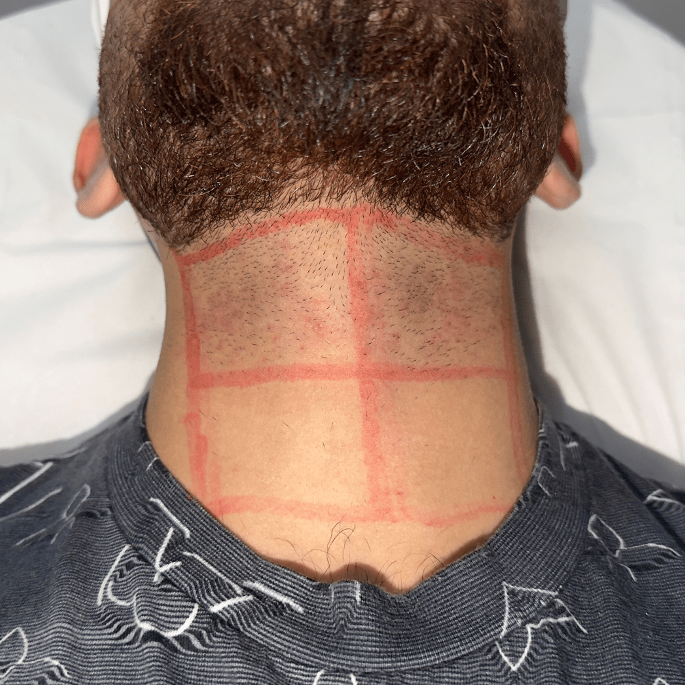 Laser Hair Removal After a Hair Transplant