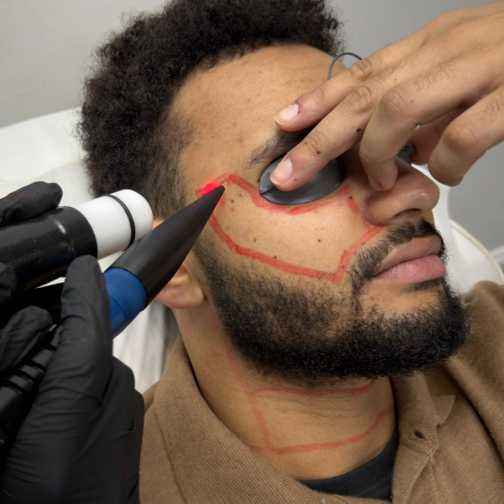 Consultation, Patch Test & Aftercare For Laser Hair Removal Treatmen
