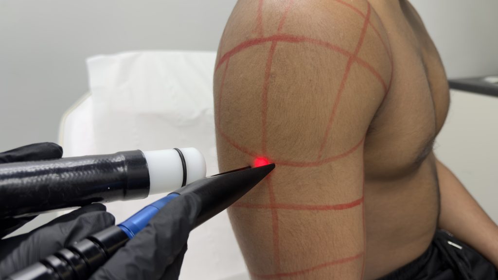 Shaving Bumps and Ingrown Hairs in Men: Why They Happen and How Laser Breaks the Cycle