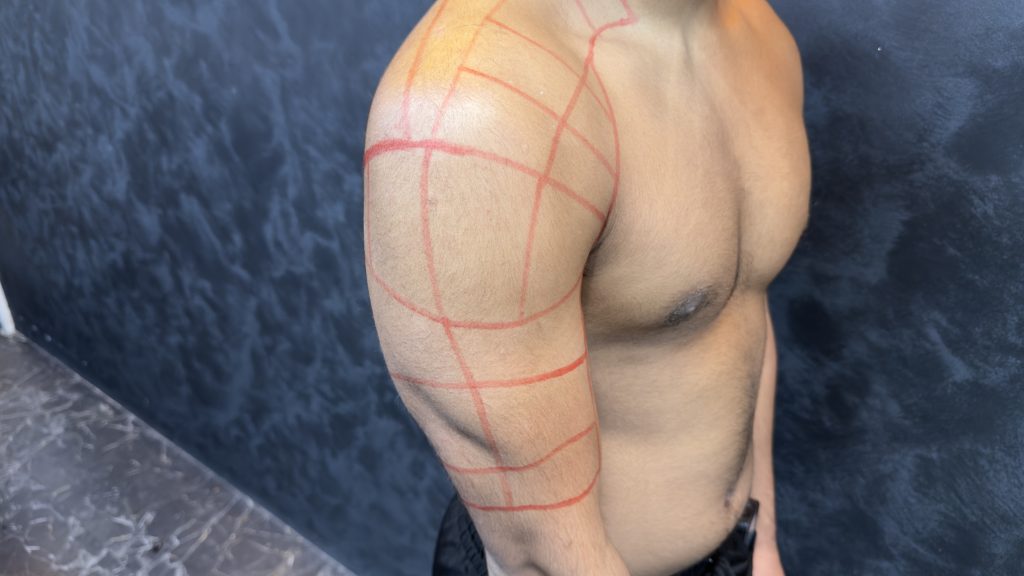Shoulder Hair Removal for Men: The Complete Laser Guide (Bradford and Oldham)