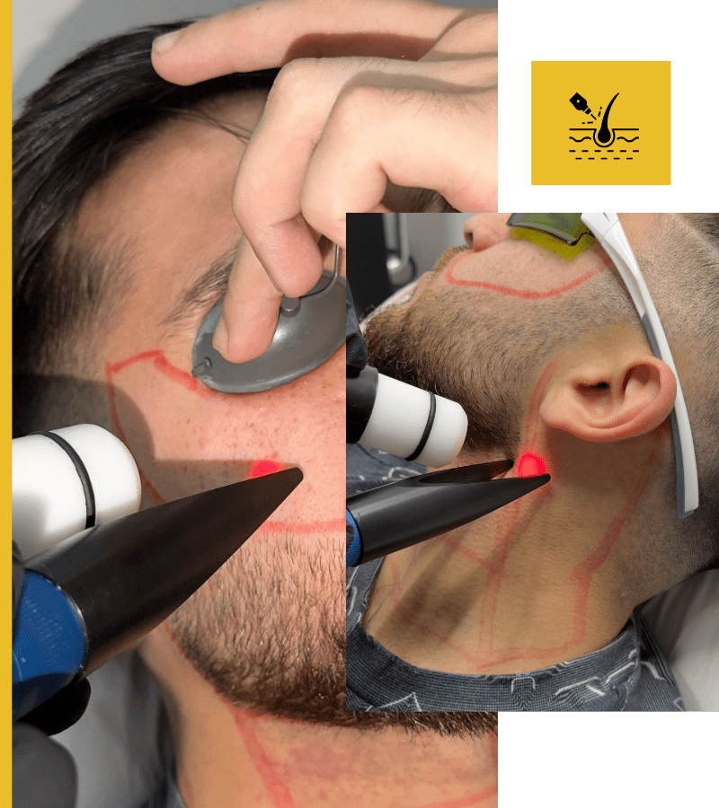 Beardline and Cheeks Laser Package For Men In Bradford and Oldham