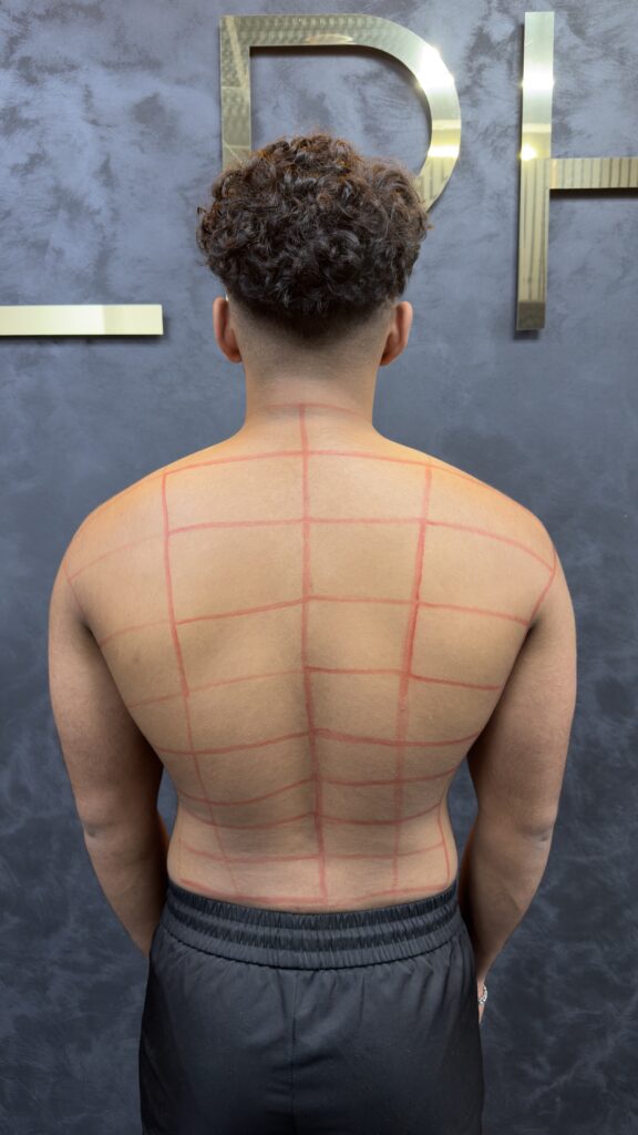 Can You Go to the Gym After Laser Hair Removal? What Men Need to Know