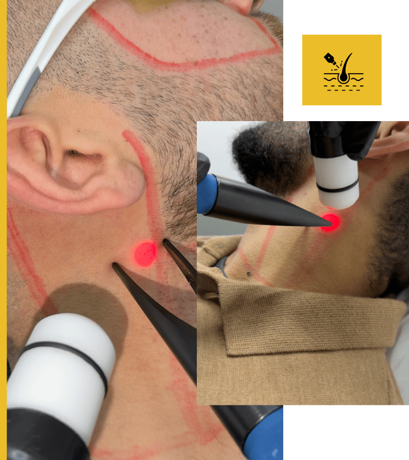 Neck + Sides of the Neck Laser Package For Men In Bradford and Oldham