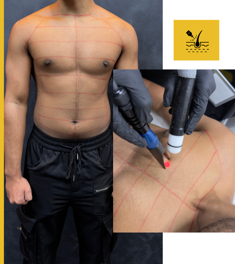 Chest + Stomach & Shoulders Laser Package For Men In Bradford and Oldham (1)