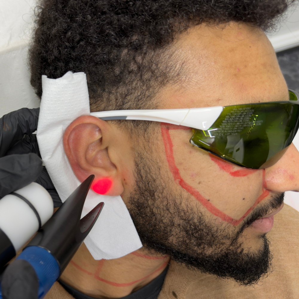 Ears Laser Hair Removal for Men