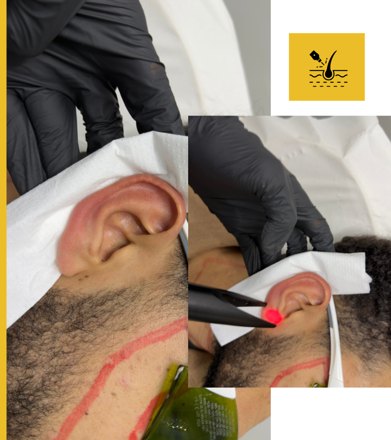 Ears Laser Package For Men In Bradford and Oldham