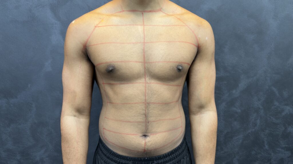 Laser Hair Removal Over Moles or Freckles