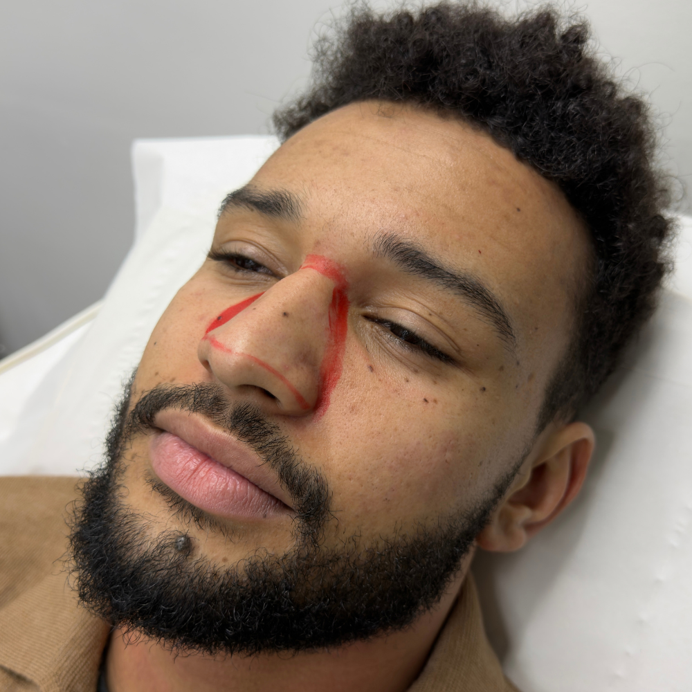 Nose Laser Hair Removal for Men alpha