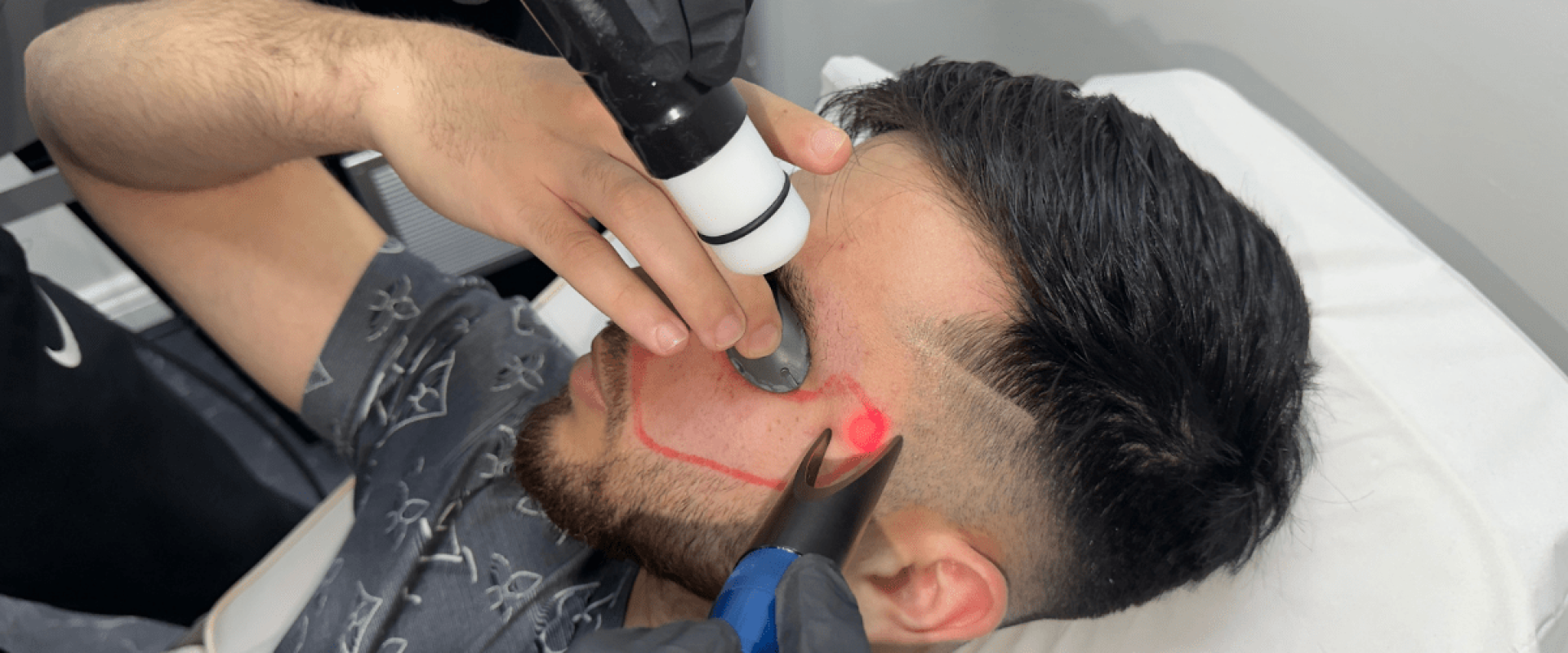 Beyond the Fade How Laser Enhances Men’s Grooming