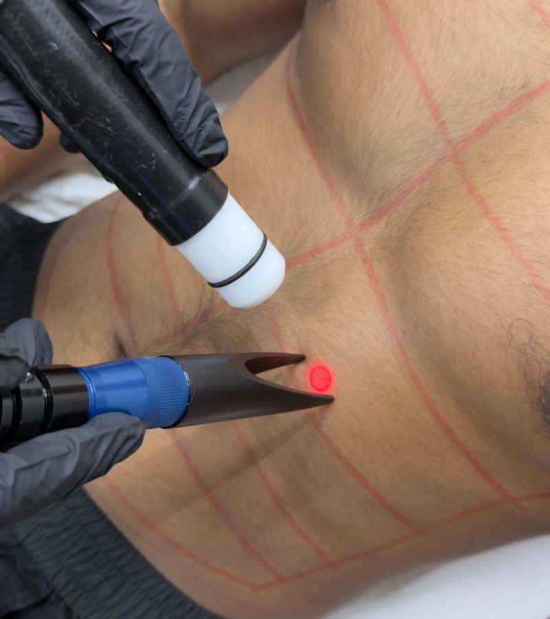 Chest Hair Removal for Men