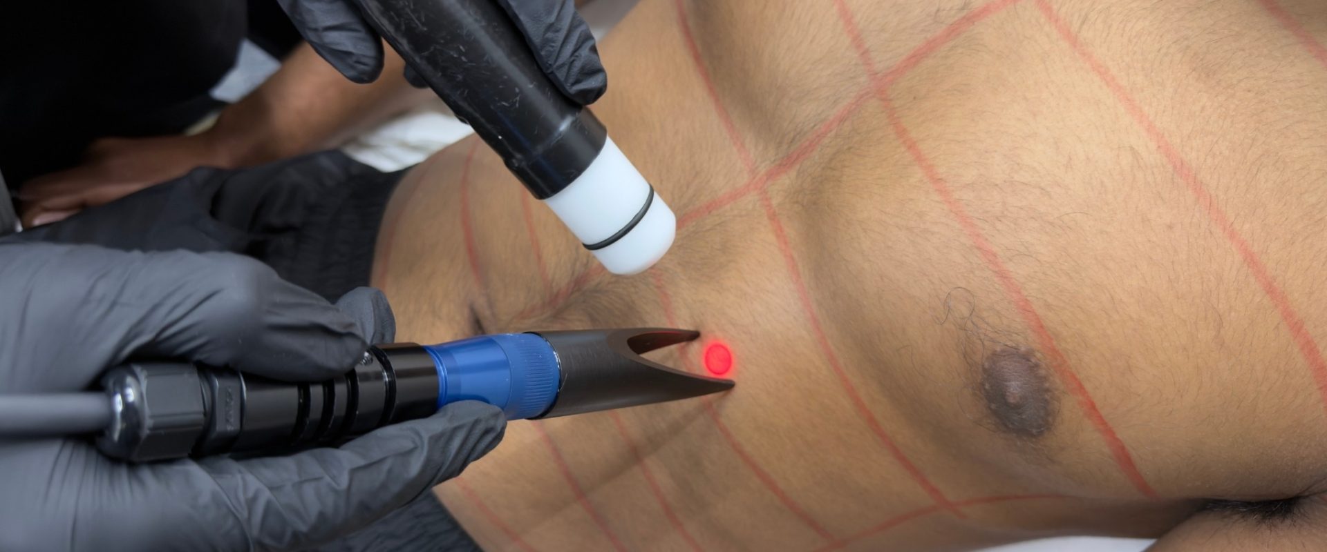 Chest Hair Removal for Men
