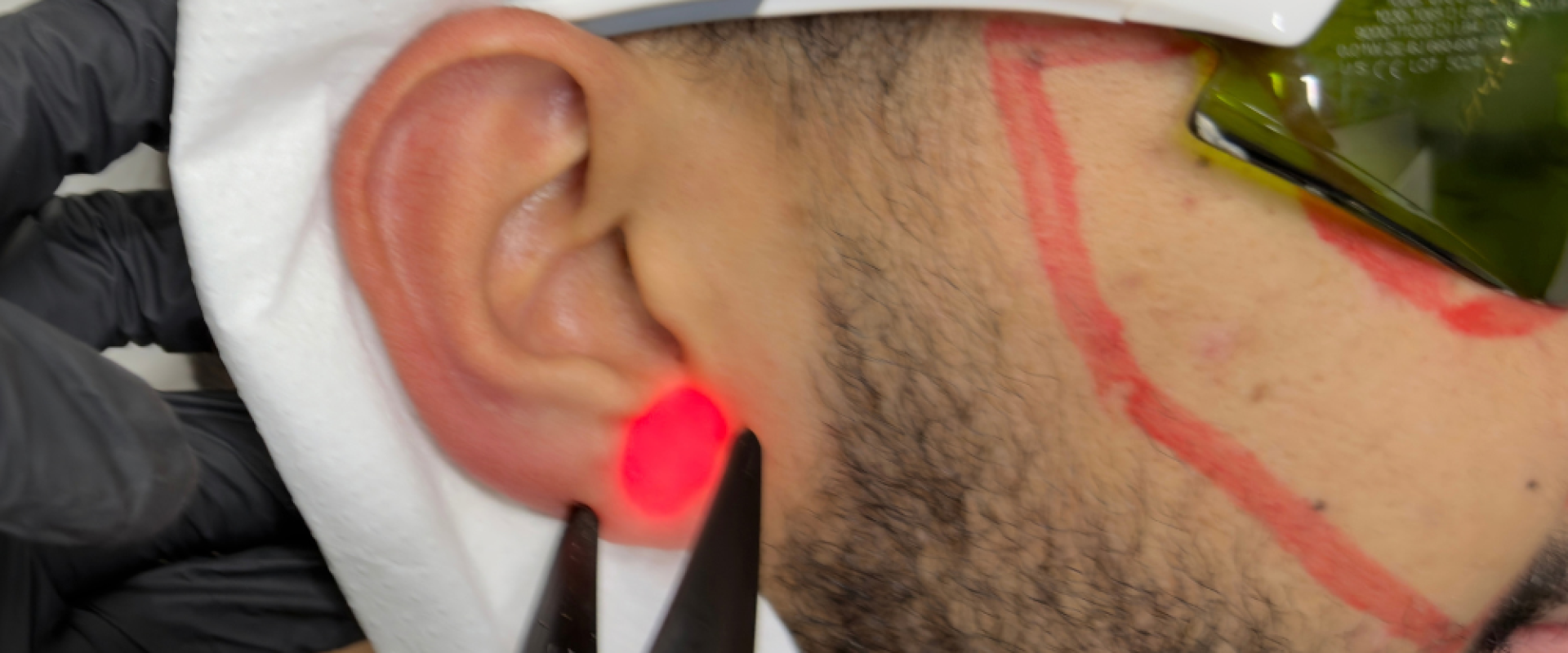 Ears Laser Hair Removal for Men.