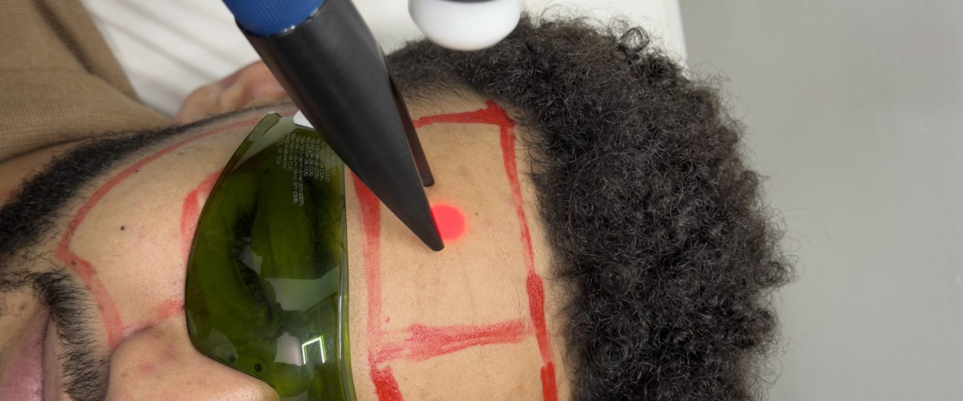 Laser Hair Removal Doesn’t Work on Every Hair Colour: Here’s Why