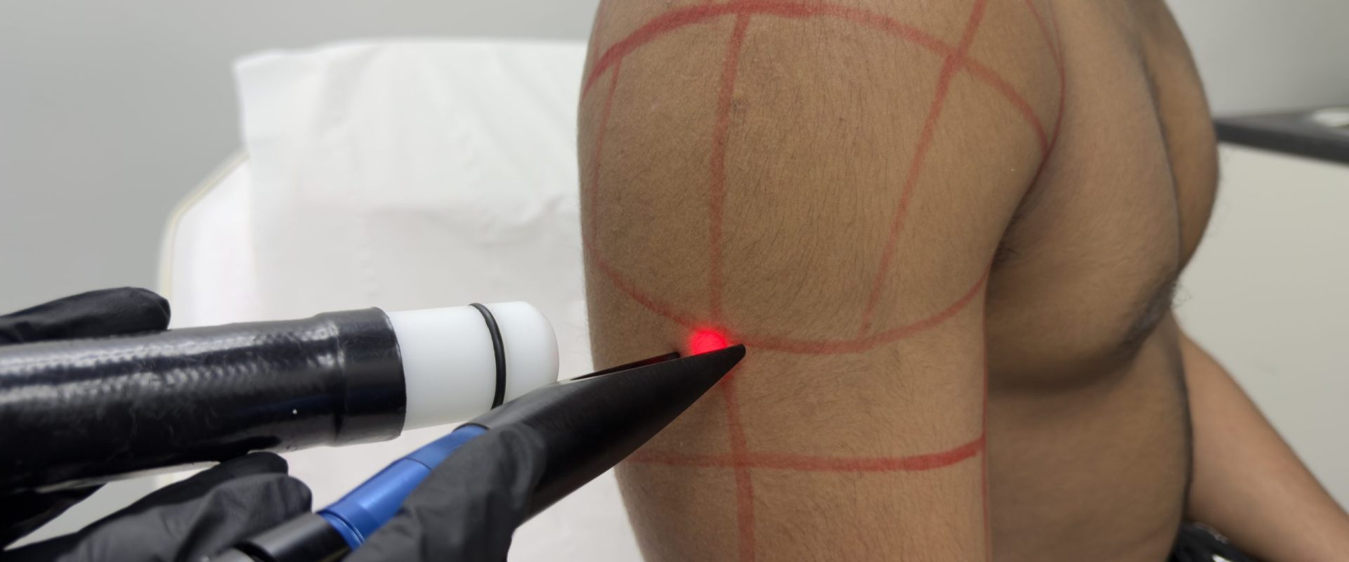 Shaving Bumps and Ingrown Hairs in Men: Why They Happen and How Laser Breaks the Cycle