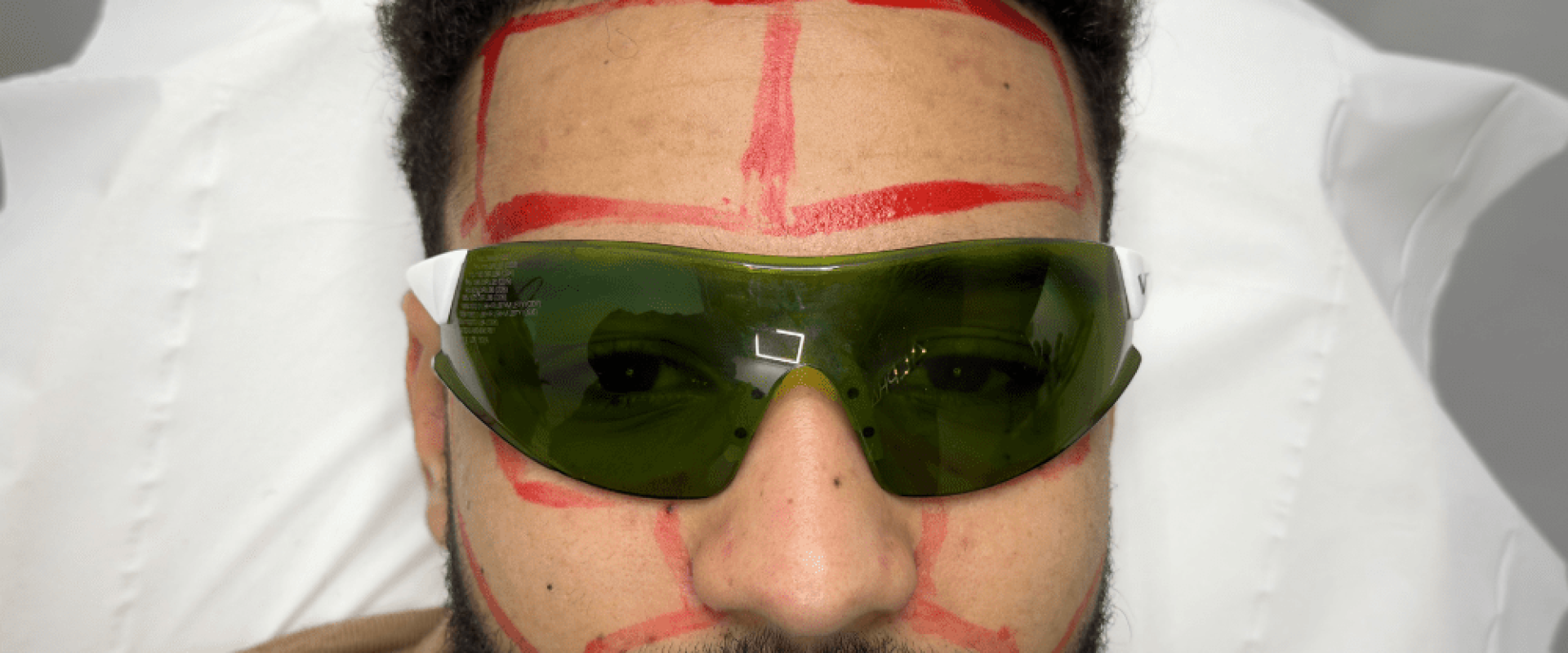 Forehead Laser Hair Removal for Mens