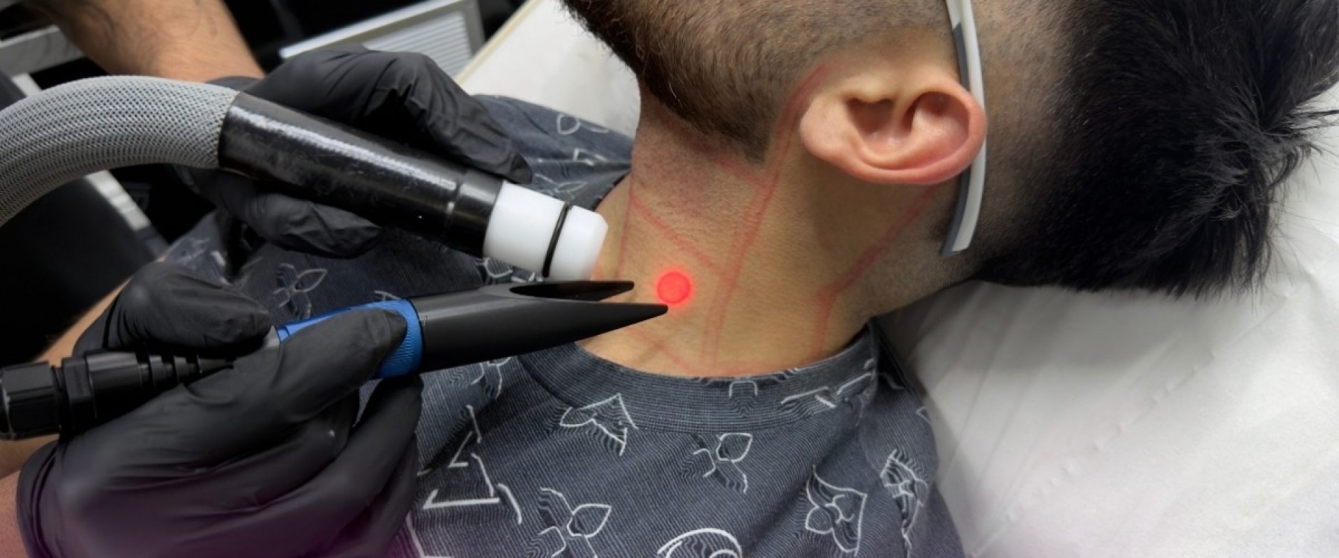 Laser Hair Removal After a Hair Transplant What Men Need to Know