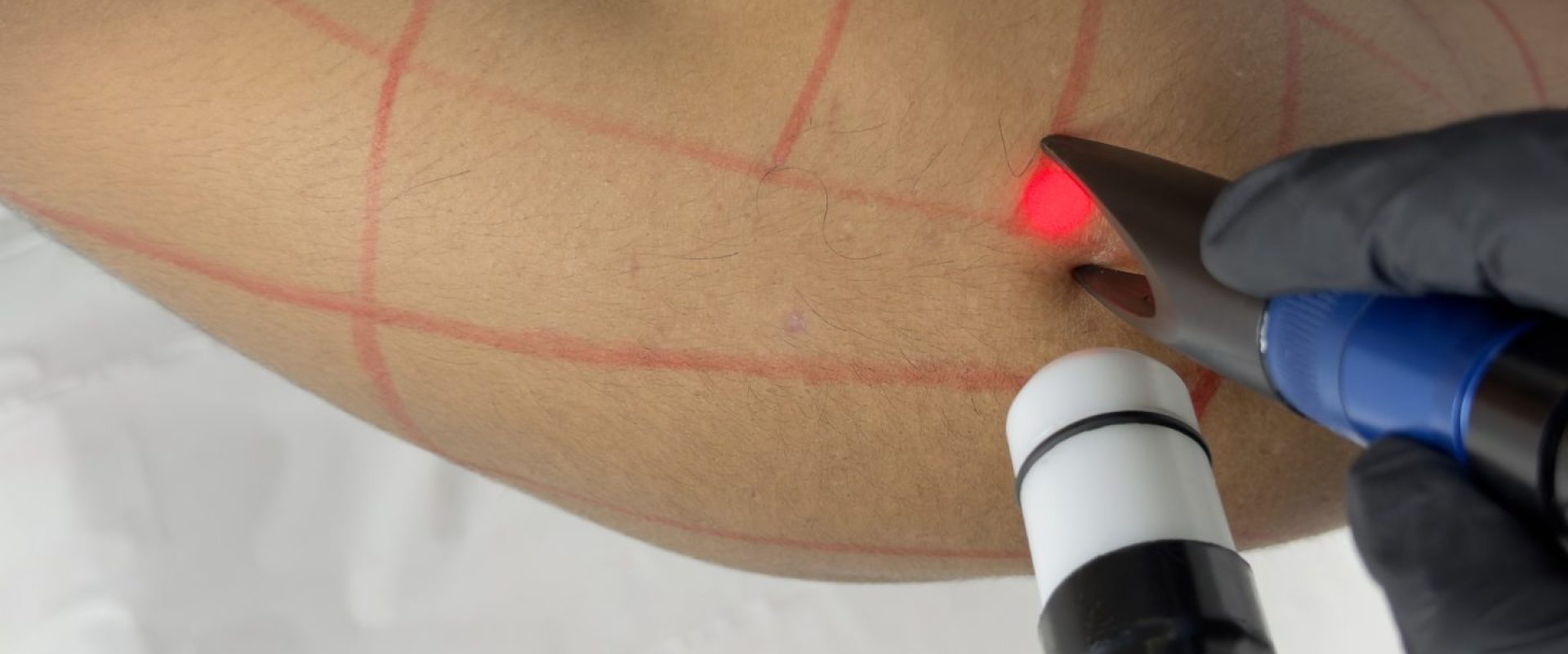 Shoulder Hair Removal for Men: The Complete Laser Guide (Bradford and Oldham)