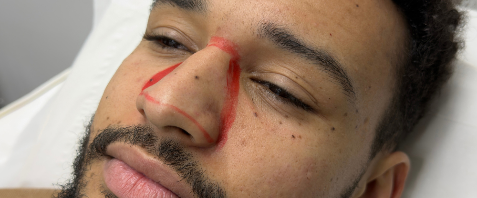 Nose Laser Hair Removal for Men alpha