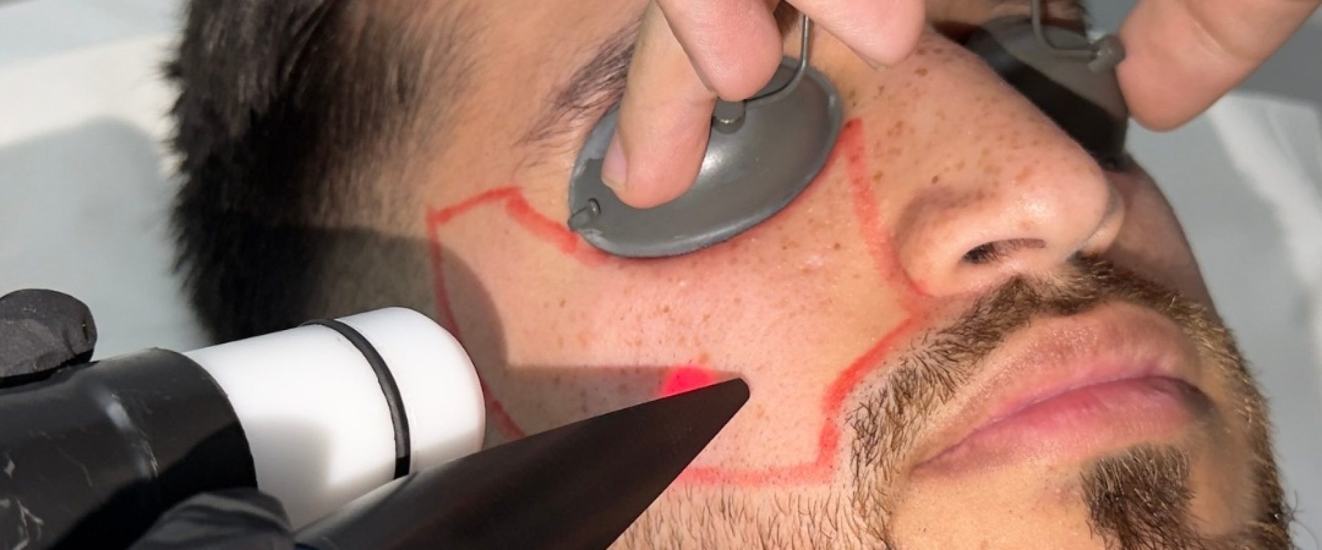 Beard Line Laser Shaping for Men: Get the Design Right First
