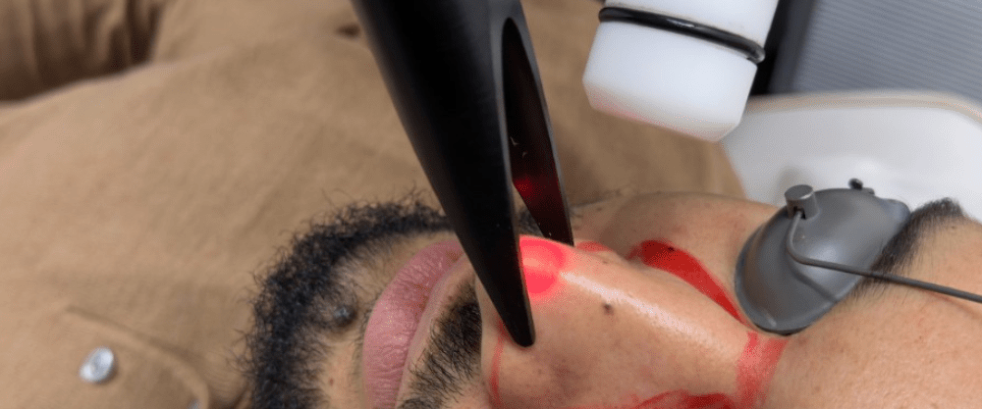 Recovery After Laser Hair Removal: Complete Aftercare Guide