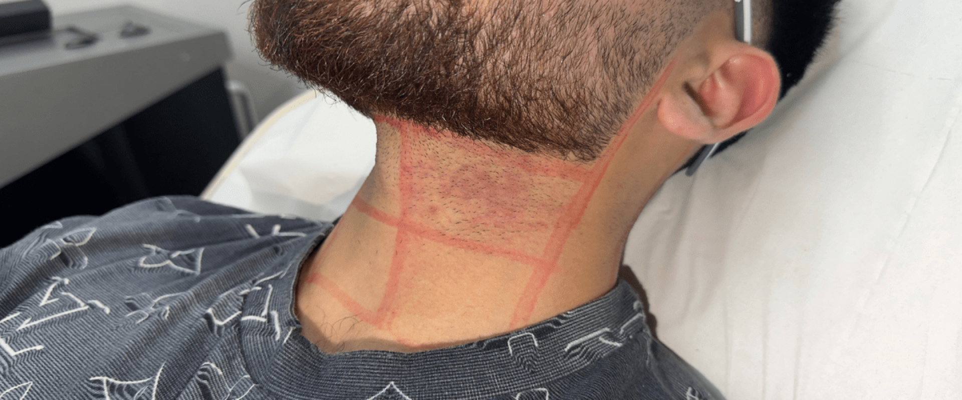 Beard Line Laser Hair Removal: Precision Grooming for Sharp Definition