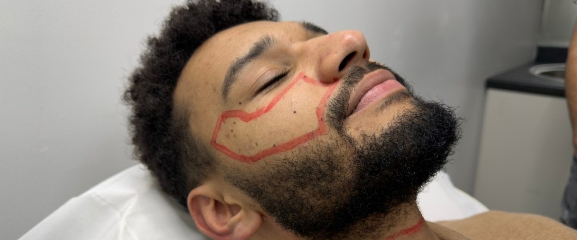 Beard Line Laser Shaping for Men: Get the Design Right First