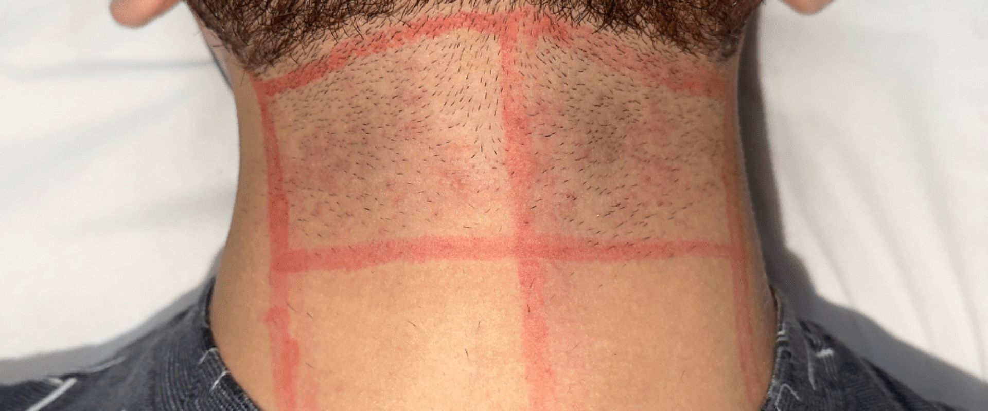 Laser Hair Removal After a Hair Transplant